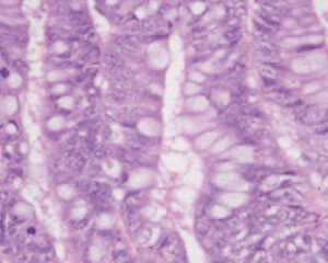 Primary cancer